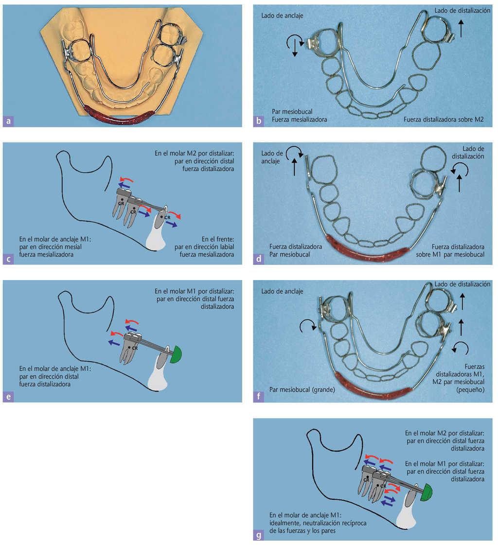 El Aparato Lizat Para La Distalizacion Unilateral De Molares En El Maxilar Inferior Elaboracion Protesica Biomecanica Ejemplos De Tratamiento Quintessence Tecnica