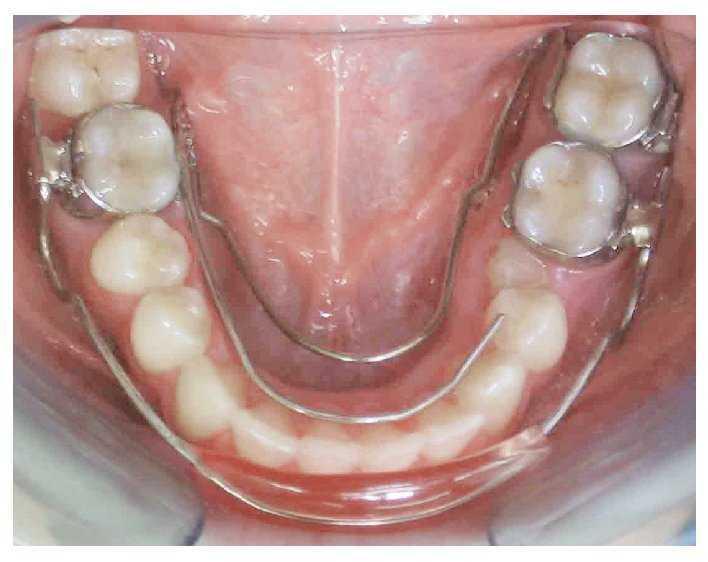 El Aparato Lizat Para La Distalizacion Unilateral De Molares En El Maxilar Inferior Elaboracion Protesica Biomecanica Ejemplos De Tratamiento Quintessence Tecnica