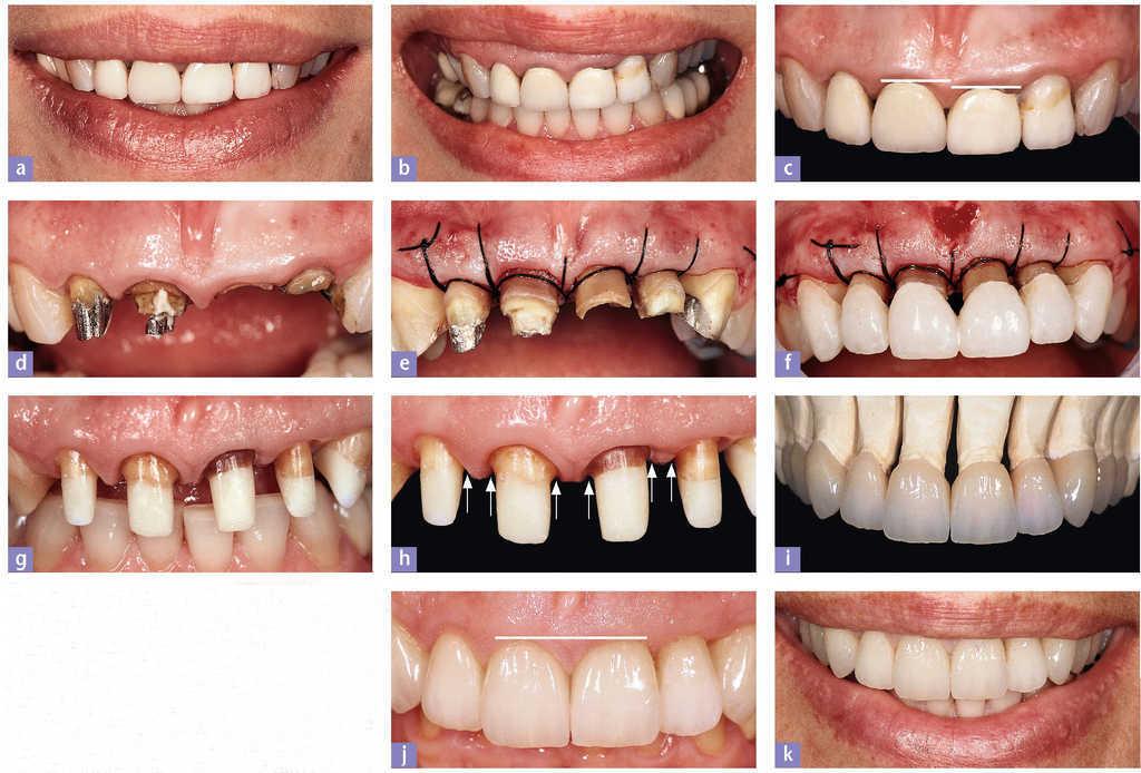 telar Equipar sobras Análisis dentolabial.3.ª parte: Línea de sonrisa | Quintessence Técnica