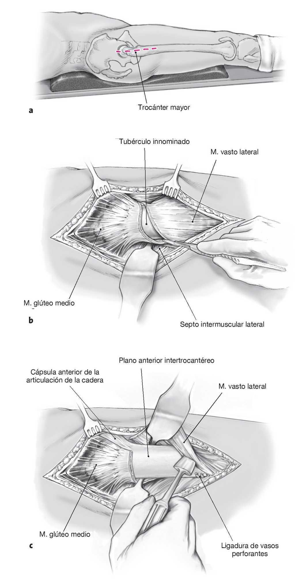 Osteotomia Intertrocanterea Correctora De Imhauser Tecnicas Quirurgicas En Ortopedia Y Traumatologia Osteotomia Intertrocanterea Correctora De Imhauser Tecnicas Quirurgicas En Ortopedia Y Traumatologia