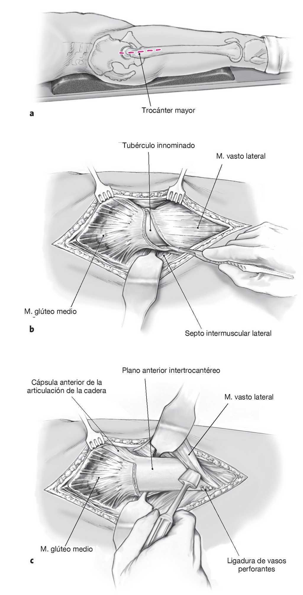 Osteotomia Intertrocanterea Correctora De Imhauser Tecnicas Quirurgicas En Ortopedia Y Traumatologia