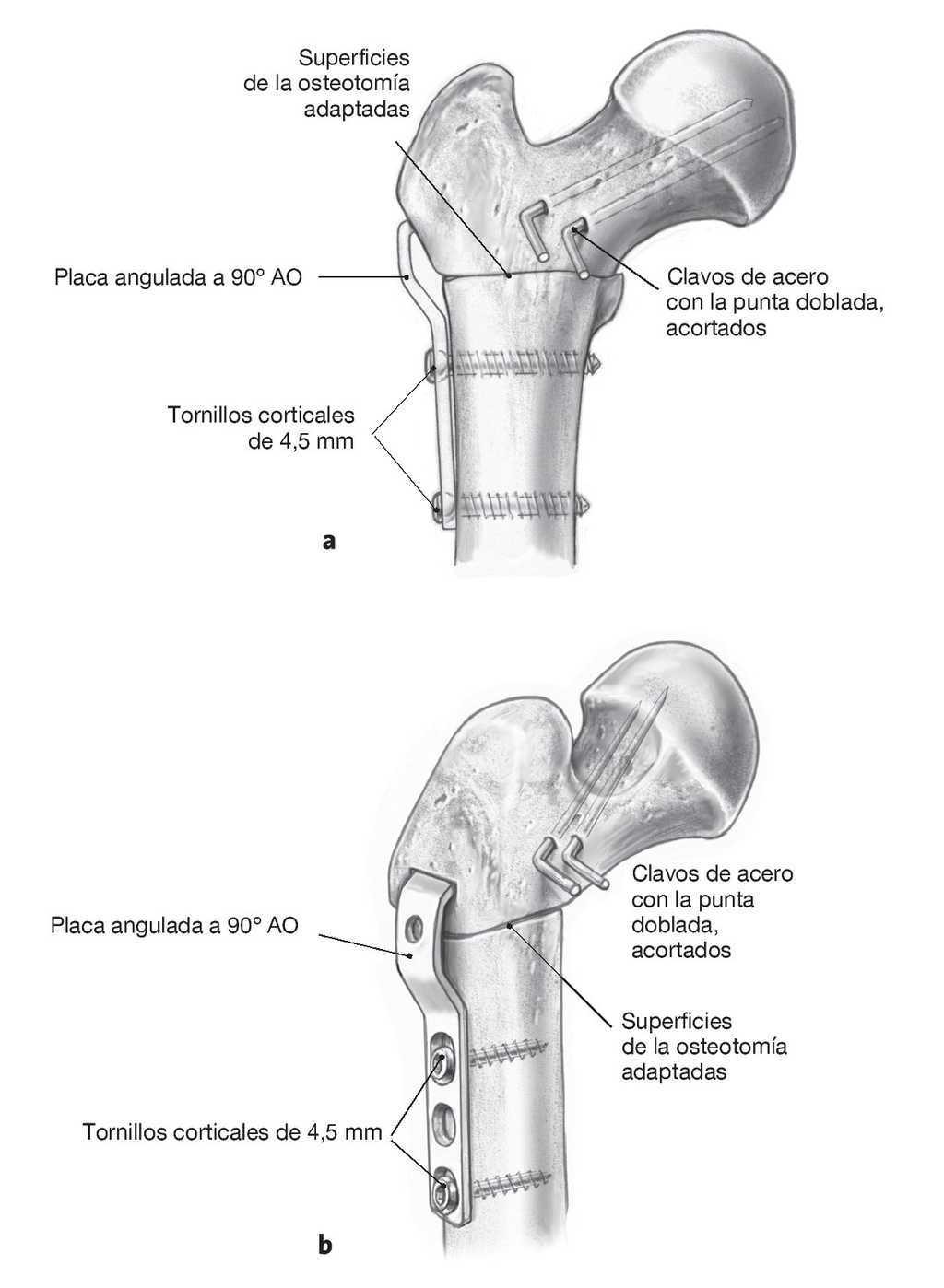 Osteotomia Intertrocanterea Correctora De Imhauser Tecnicas Quirurgicas En Ortopedia Y Traumatologia