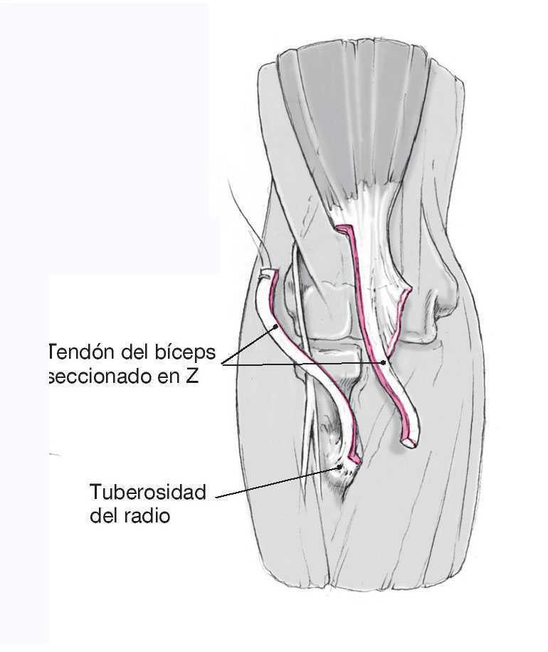 plazmolifting a csípőízület artrózisával