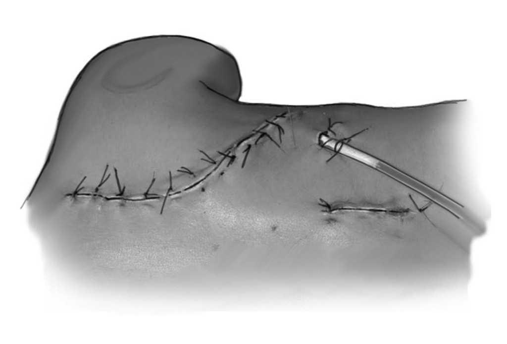 Tratamiento quirúrgico de las escoliosis con la prótesis costal vertical expansible de titanio | Técnicas Quirúrgicas en Ortopedia y Traumatología
