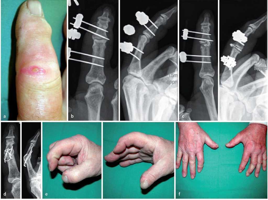 inflamație medicamentoasă a articulațiilor degetelor tratamentul articulațiilor mari