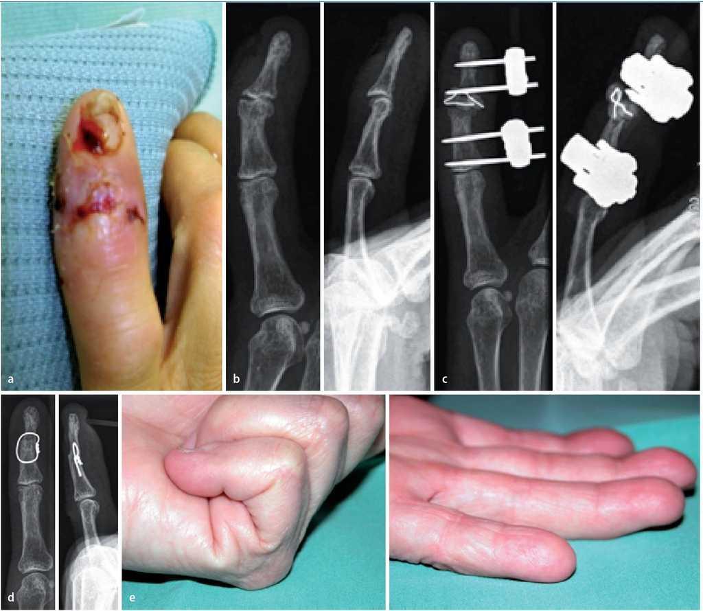 inflamație medicamentoasă a articulațiilor degetelor Danas tratamentul articulației genunchiului