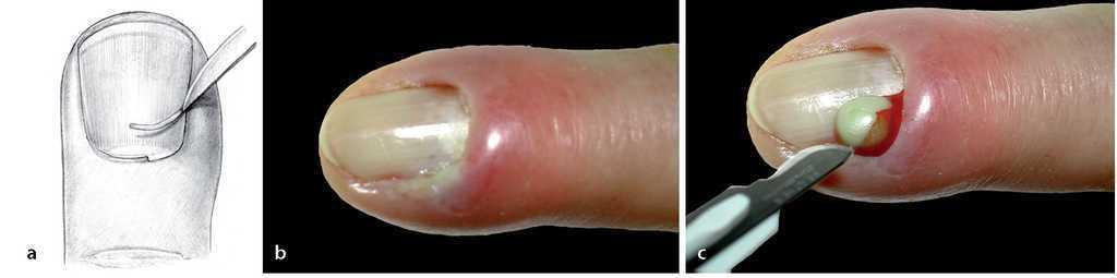 Persona australiana Borradura Vinagre Infecciones del surco ungueal de los dedos. Tratamiento de la paroniquia |  Técnicas Quirúrgicas en Ortopedia y Traumatología