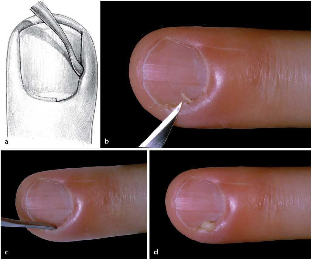 Infecciones del surco ungueal de los dedos. Tratamiento de la paroniquia |  Técnicas Quirúrgicas en Ortopedia y Traumatología