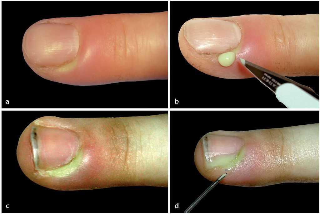 Infecciones del surco ungueal de los dedos. Tratamiento de la paroniquia |  Técnicas Quirúrgicas en Ortopedia y Traumatología