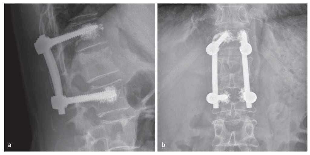 de fracturas vertebrales osteoporóticas mediante instrumentalización cemento | Técnicas Quirúrgicas en Ortopedia y Traumatología
