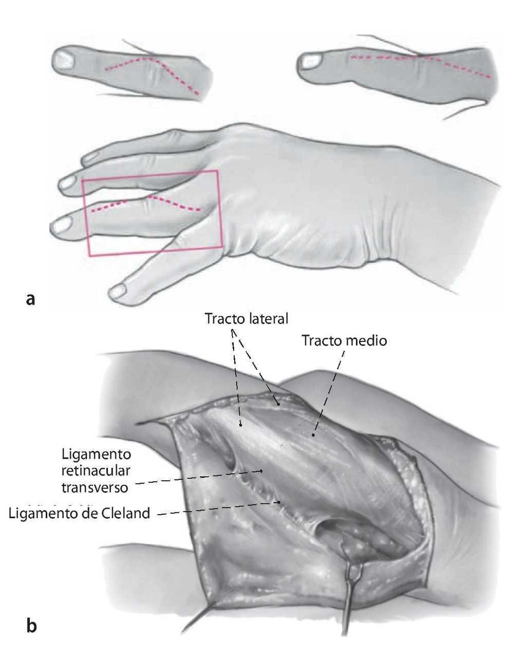 A könyökízület deformáló artrózisa fokkal. Artrózis kezelési iskola