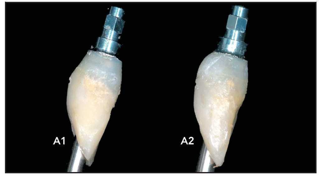 Consideraciones del pilar del implante y el contorno de la corona