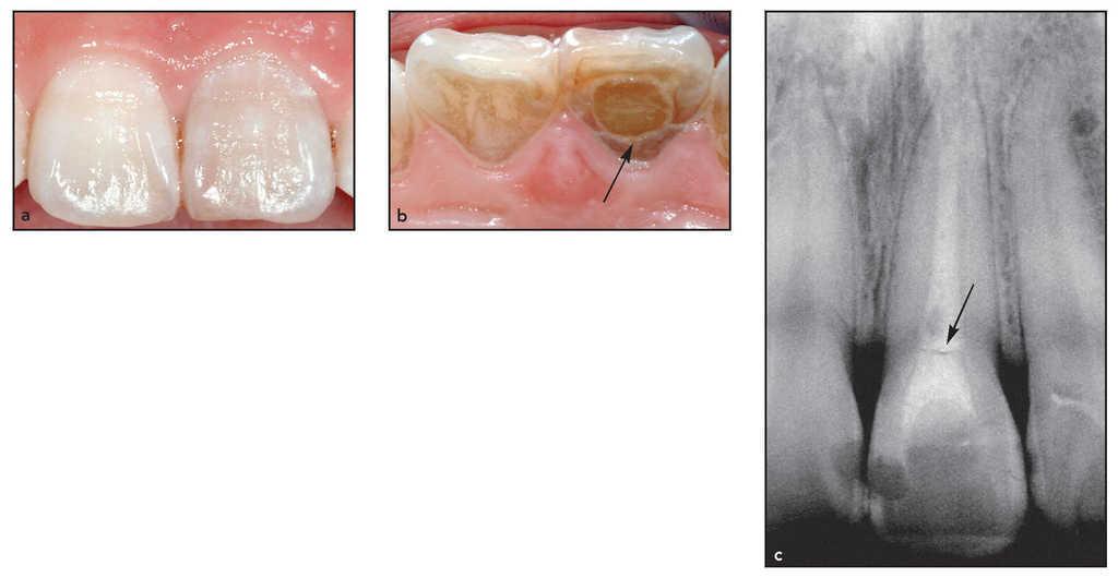 Siento Presión En Corona De Dental Reinserción raíz-corona en una fractura dental subgingival grave