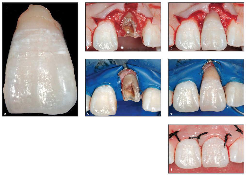 Reinserción raízcorona en una fractura dental subgingival grave