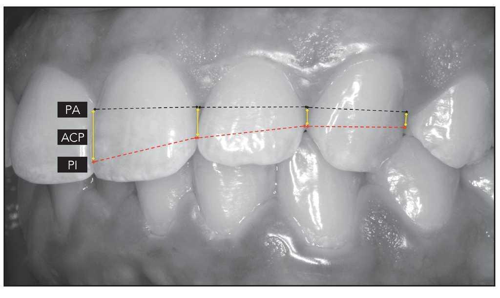 Areas De Contacto Proximal De La Denticion Maxilar Anterior Revista Internacional De Odontologia Restauradora Y Periodoncia