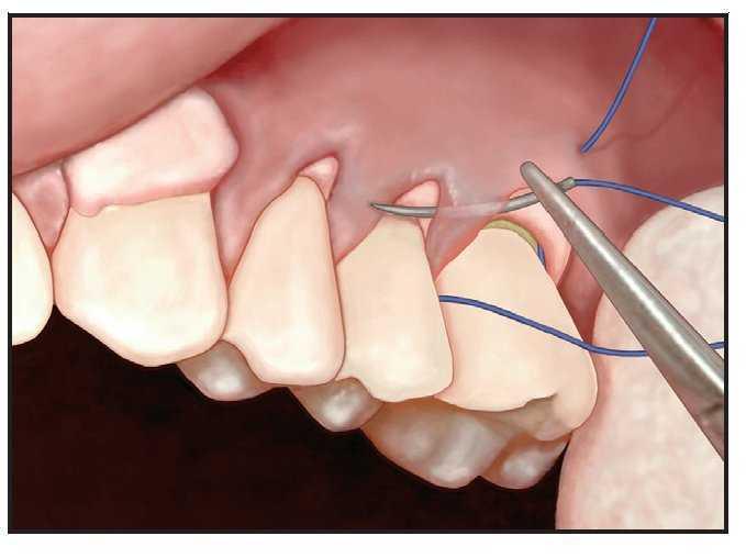 Metodo De Sutura Subpapilar Continua Suspensoria Para El Injerto De Tejido Blando Usando La Tecnica De Tunelizacion Revista Internacional De Odontologia Restauradora Y Periodoncia