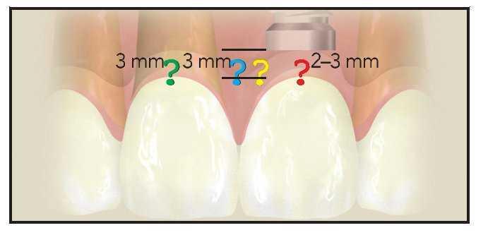 Requisitos Tridimensionales De Hueso Y Tejidos Blandos Para La Optimizacion De Los Resultados Esteticos En Casos Complicados Con Multiples Implantes Revista Internacional De Odontologia Restauradora Y Periodoncia