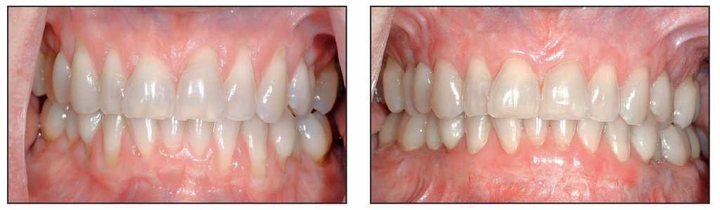 Tecnica Modificada Del Injerto Gingival Sin Tension Utilizando Una Matriz Dermica Acelular Revista Internacional De Odontologia Restauradora Y Periodoncia