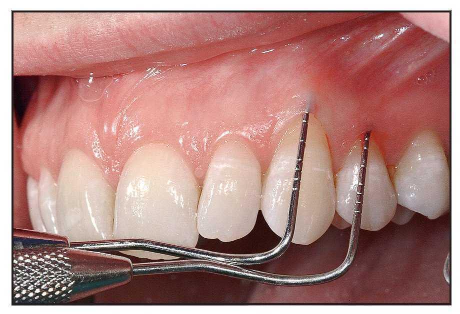 Tecnica Modificada Del Injerto Gingival Sin Tension Utilizando Una Matriz Dermica Acelular Revista Internacional De Odontologia Restauradora Y Periodoncia