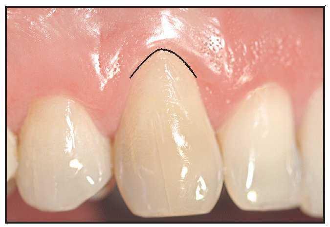 Tecnica Para La Identificacion Y Reconstruccion Del Nivel De La Union Cemento Esmalte Utilizando Un Tratamiento Combinado Periodontico Y De Restauracion De La Recesion Gingival Estudio Clinico Prospectivo Revista Internacional De Odontologia