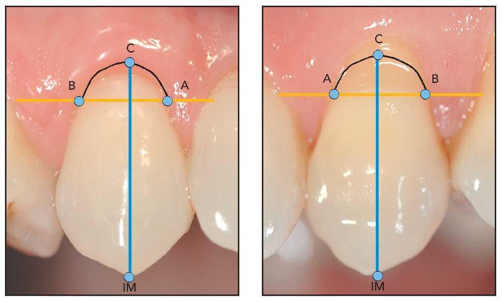 Tecnica Para La Identificacion Y Reconstruccion Del Nivel De La Union Cemento Esmalte Utilizando Un Tratamiento Combinado Periodontico Y De Restauracion De La Recesion Gingival Estudio Clinico Prospectivo Revista Internacional De Odontologia