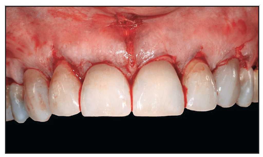 Uso De La Tecnica Del Tunel Y La Matriz Dermica Acelular En El Tratamiento De Multiples Dientes Adyacentes Con Recesion Gingival En La Zona Estetica Revista Internacional De Odontologia Restauradora Y