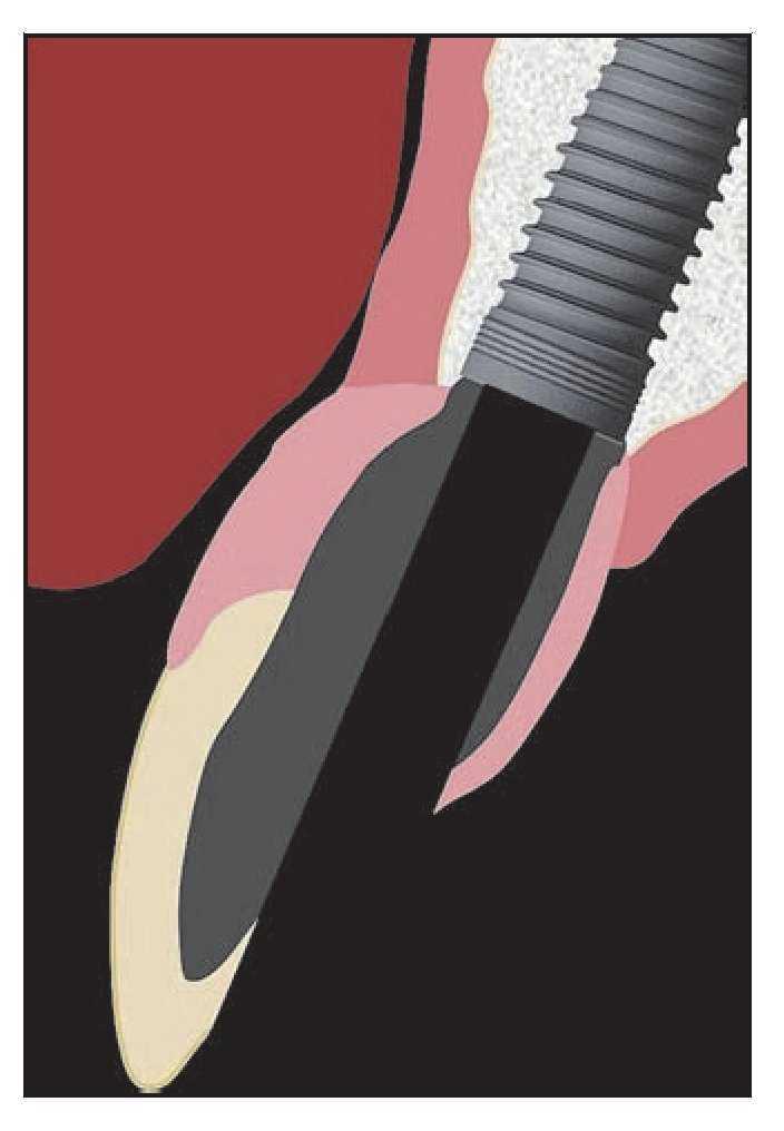 Reconstruccion Gingival Protesica En Protesis Parciales Fijas Tercera Parte Procedimientos De Laboratorio Y Mantenimiento Revista Internacional De Odontologia Restauradora Y Periodoncia