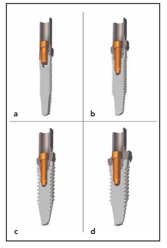 Influencia De La Longitud Diametro Y Geometria Del Implante En La Distribucion De Las Tensiones Un Analisis Con Un Modelo De Elementos Finitos Revista Internacional De Odontologia Restauradora Y Periodoncia