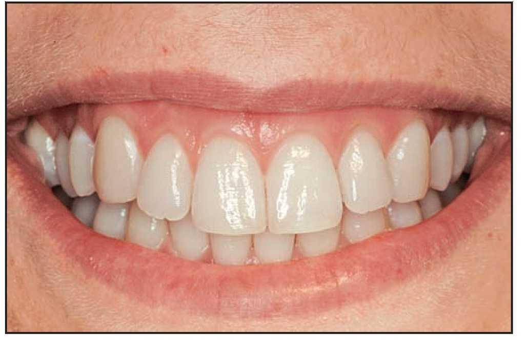 Tratamiento Quirurgico Combinado De La Asimetria Gingival Presentacion De Un Caso Revista Internacional De Odontologia Restauradora Y Periodoncia