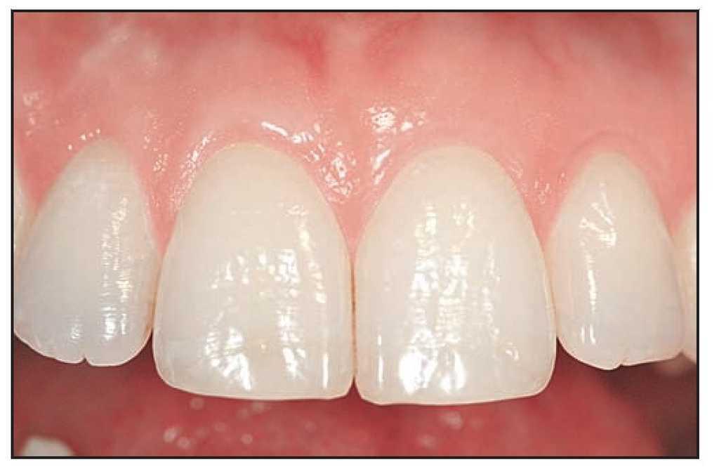 Tratamiento Quirurgico Combinado De La Asimetria Gingival Presentacion De Un Caso Revista Internacional De Odontologia Restauradora Y Periodoncia