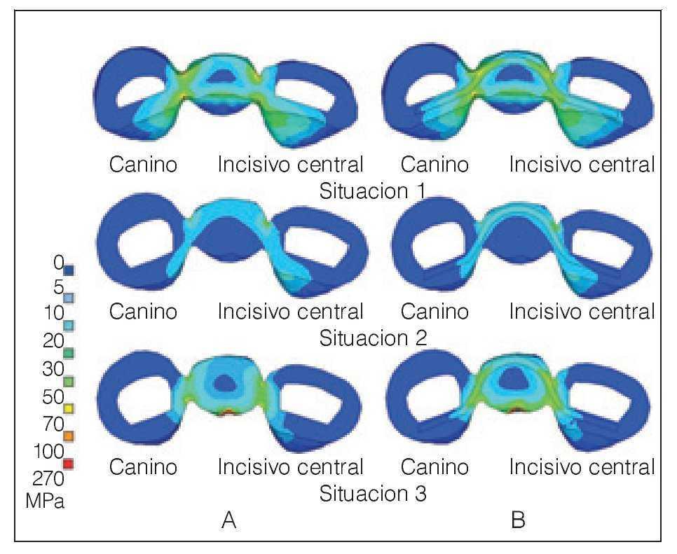 Diseno De La Estructura Para Una Protesis Anterior Parcial Fija De Composite Hibrido Reforzado Con Fibra Un Estudio Tridimensional De Elementos Finitos Revista Internacional De Protesis Estomatologica