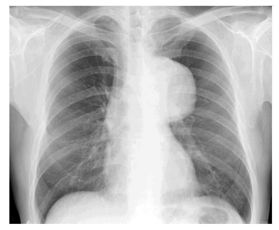 Resultado de imagen para aneurisma de aorta en radiografia de torax