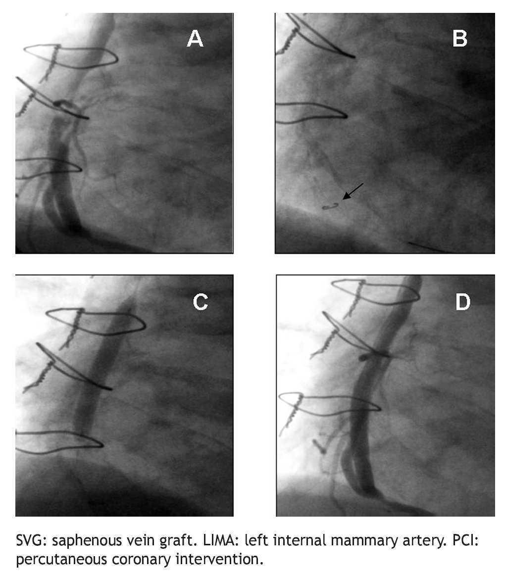 Download Long Term Outcomes Of Saphenous Vein Graft Stenting Compared With Native Coronary Artery Stenting In Patients With Previous Coronary Artery Bypass Graft Surgery Archivos De Cardiologia De Mexico
