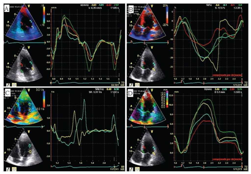 Does layer-specific strain using speckle tracking echocardiography improve  the assessment of left ventricular myocardial deformation? A review -  ScienceDirect