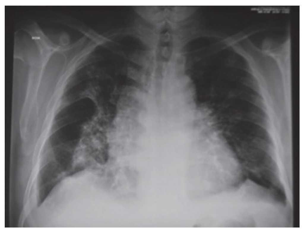 ¿Qué produce los infiltrados pulmonares
