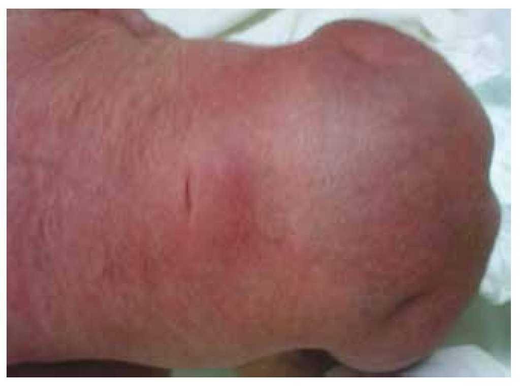 Caudal regression syndrome: A case report | Medicina Universitaria