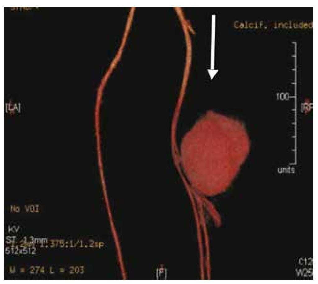 Surgical treatment of a pseudoaneurysm of the femoral artery secondary to a gunshot wound. Clinical case report | Medicina Universitaria Surgical treatment of a pseudoaneurysm of the femoral artery secondary to a gunshot wound. Clinical case report | Medicina Universitaria