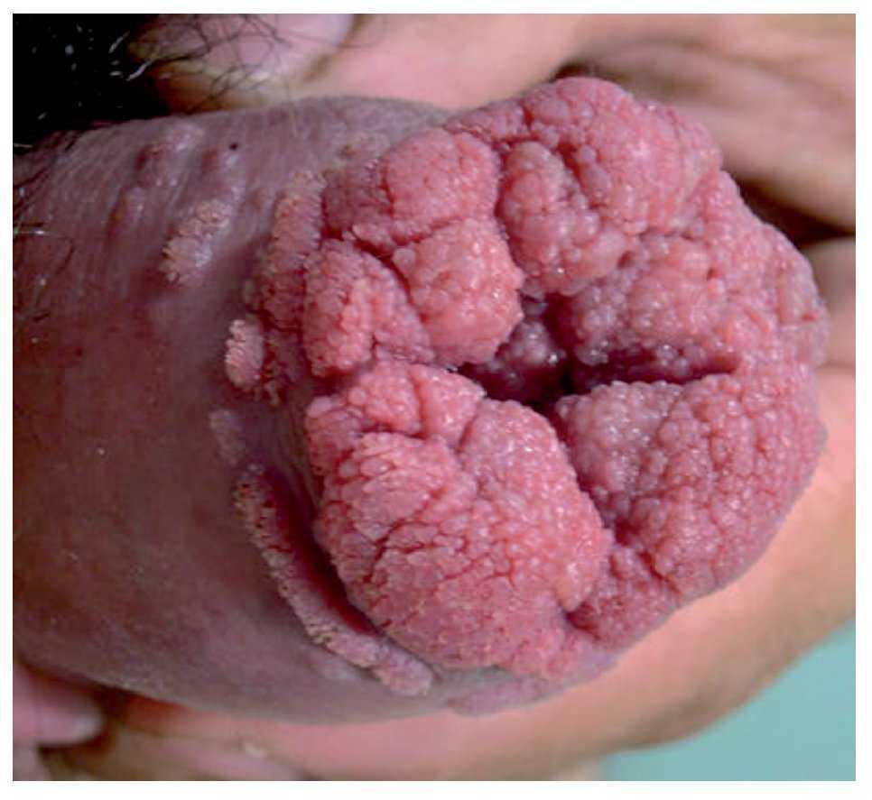 Cáncer de pene. Revisión de las características clínico-patológicas | Gaceta Mexicana de Oncología