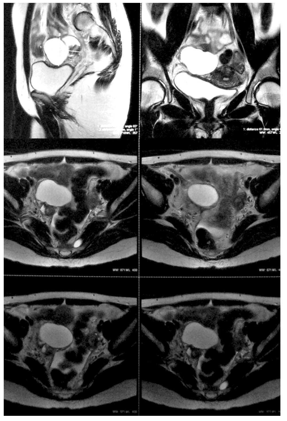 cobertura tallarines gorra Tumor pélvico asociado a incremento del CA125 por neoplasia benigna. Presentación de un caso resuelto por vía laparoscópica | Gaceta Mexicana de Oncología cobertura tallarines gorra Tumor pélvico asociado a incremento del CA125 por neoplasia benigna. Presentación de un caso resuelto por vía laparoscópica | Gaceta Mexicana de Oncología