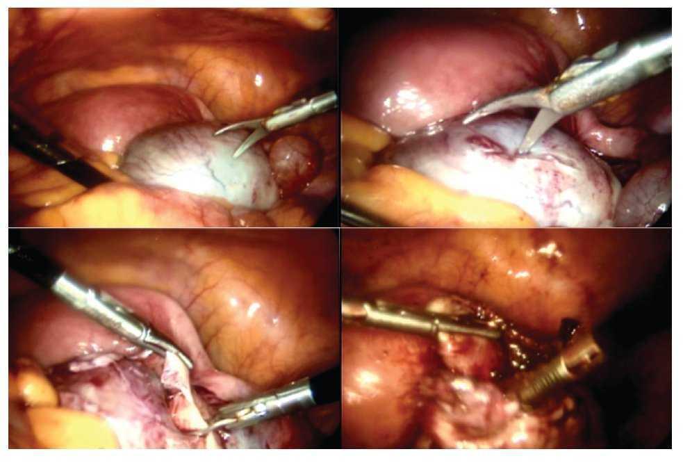 Ooforectomía O Retiro Quirúrgico Del Concepto Del Ovario O De Los