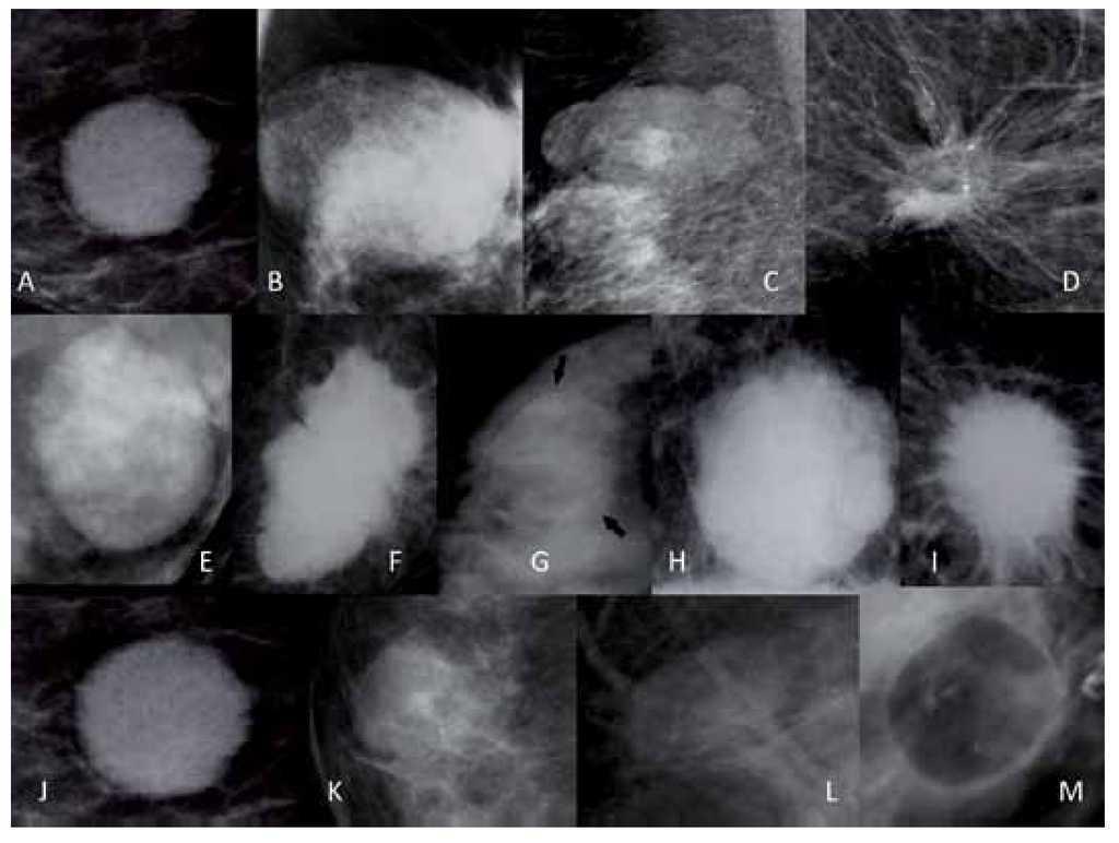 Nodulos Caracterizacion Y Categorizacion Gaceta Mexicana De Oncologia