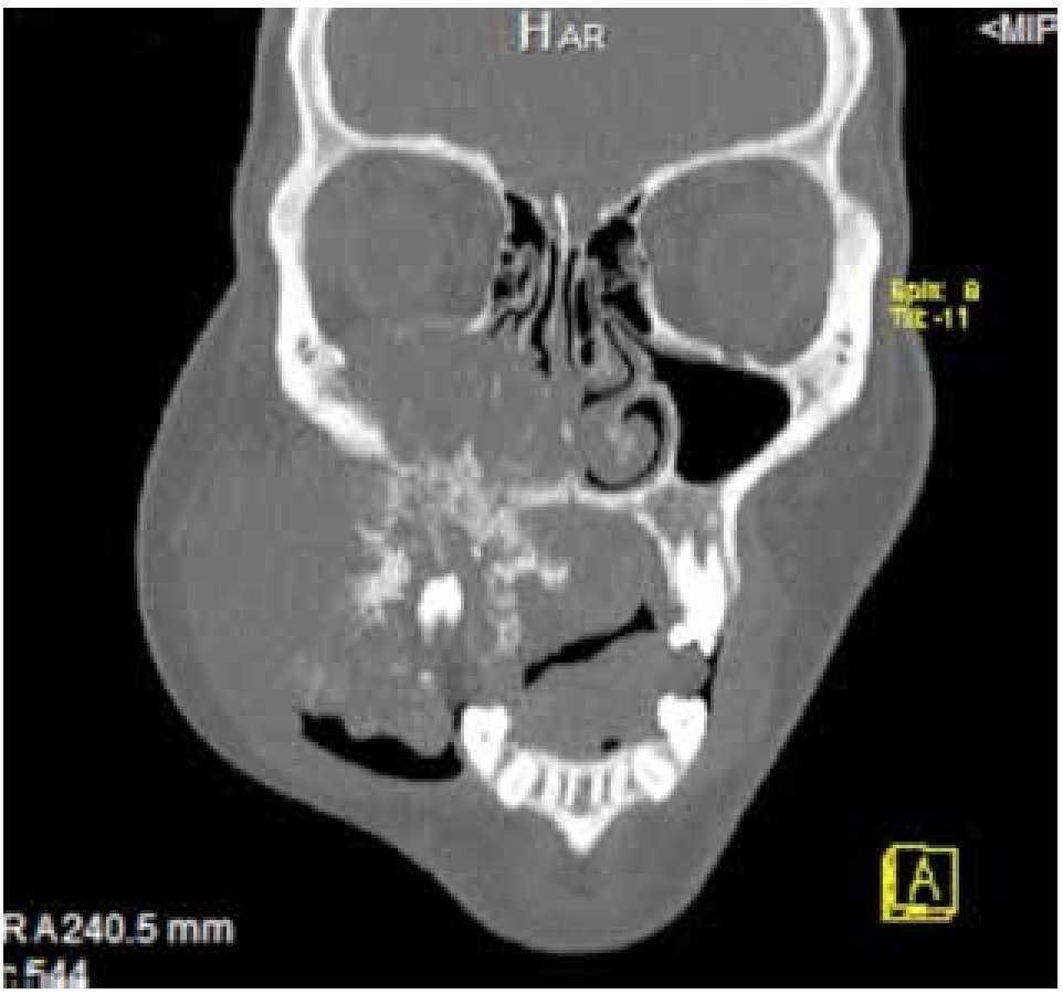 Osteosarcoma