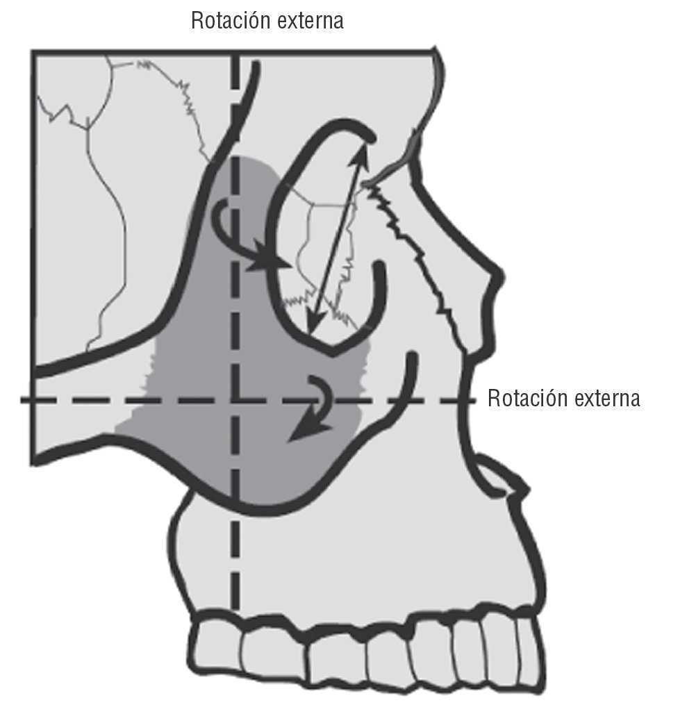 Tecnica Articular Para Disfuncion De Malar En Eversion Osteopatia Cientifica