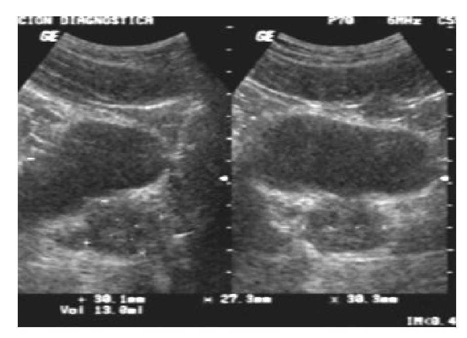 Examen ecografic al prostatei transabdominal