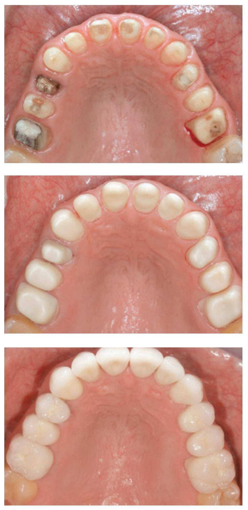 Zirconia En Odontologia Segunda Parte Revolucion Clinica Basada En La Evidencia The European Journal Of Esthetic Dentistry