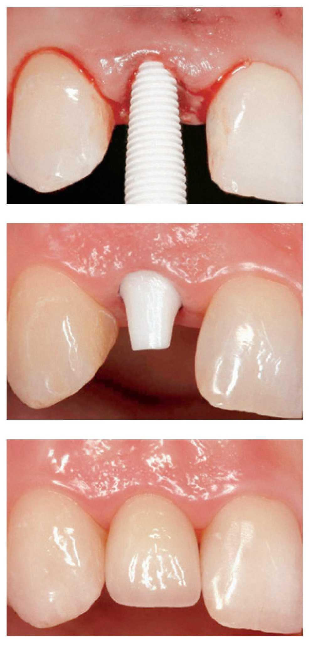 Zirconia En Odontologia Segunda Parte Revolucion Clinica Basada En La Evidencia The European Journal Of Esthetic Dentistry