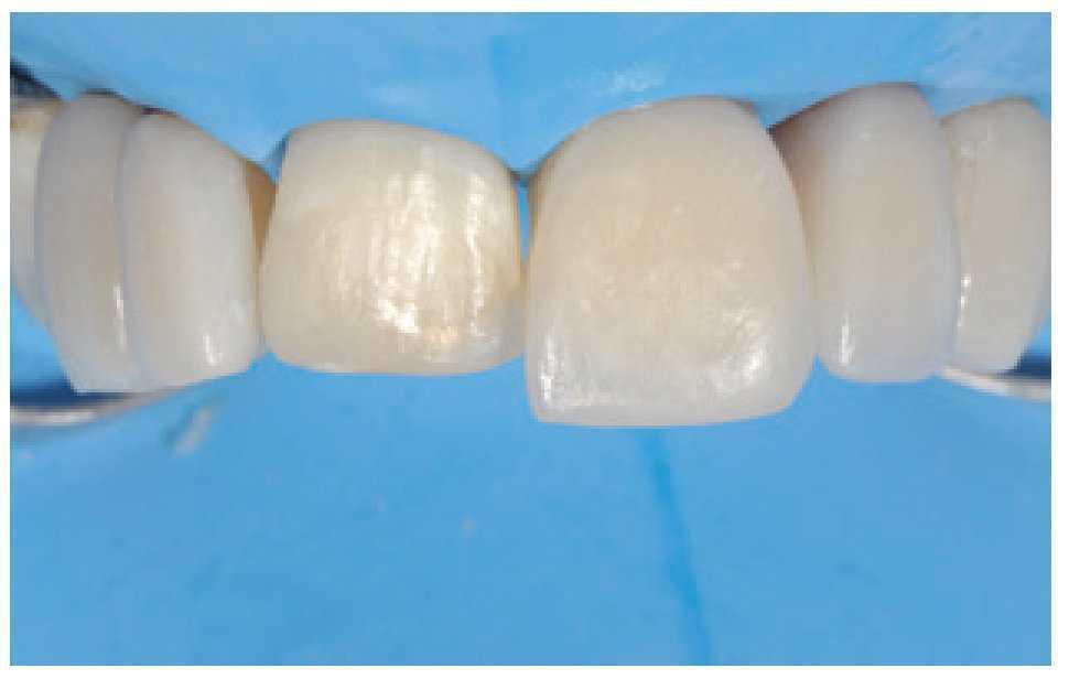 Composites en la clínica diaria cómo elegir el material correcto y simplificar las técnicas de