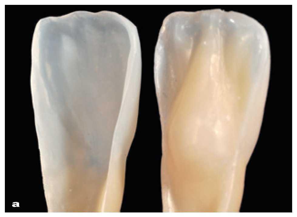 Composites en la clínica diaria cómo elegir el material correcto y simplificar las técnicas de