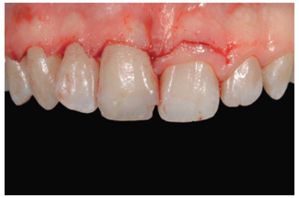 Composites en la clínica diaria cómo elegir el material correcto y simplificar las técnicas de