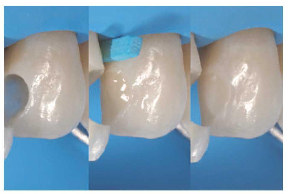 Composites en la clínica diaria cómo elegir el material correcto y simplificar las técnicas de